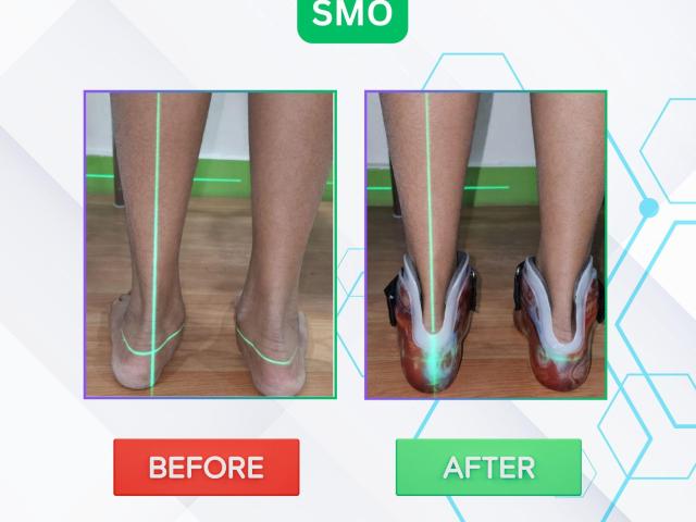 Best Artificial Leg  in Hyderabad | CareVale Prosthetics