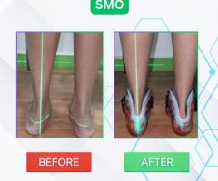 Best Artificial Leg  in Hyderabad | CareVale Prosthetics