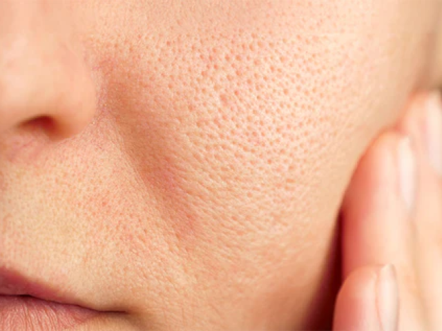 Open Pores Treatment in Dadar East