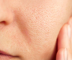 Open Pores Treatment in Dadar East