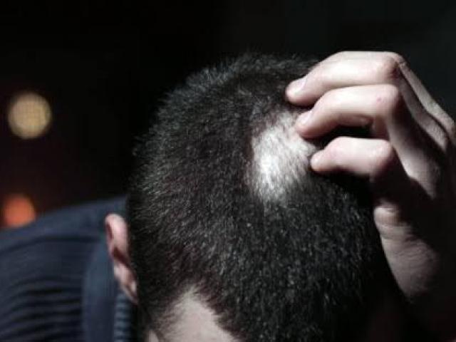 Alopecia Areata Treatment in Matunga
