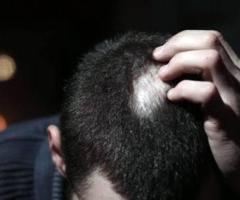 Alopecia Areata Treatment in Matunga