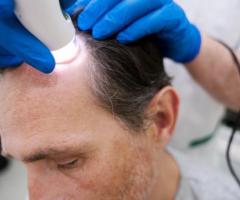 Best Hair Transplantation in Jubilee Hills | Hyderabad